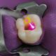 آیا درمان ریشه دندان و عصب کشی با لیزر امکان پذیر است؟